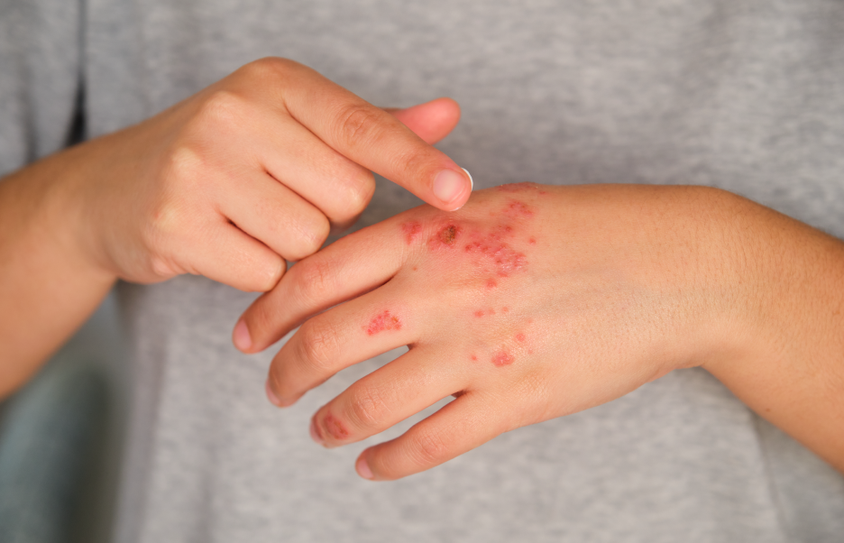 ¿Qué es la Psoriasis?