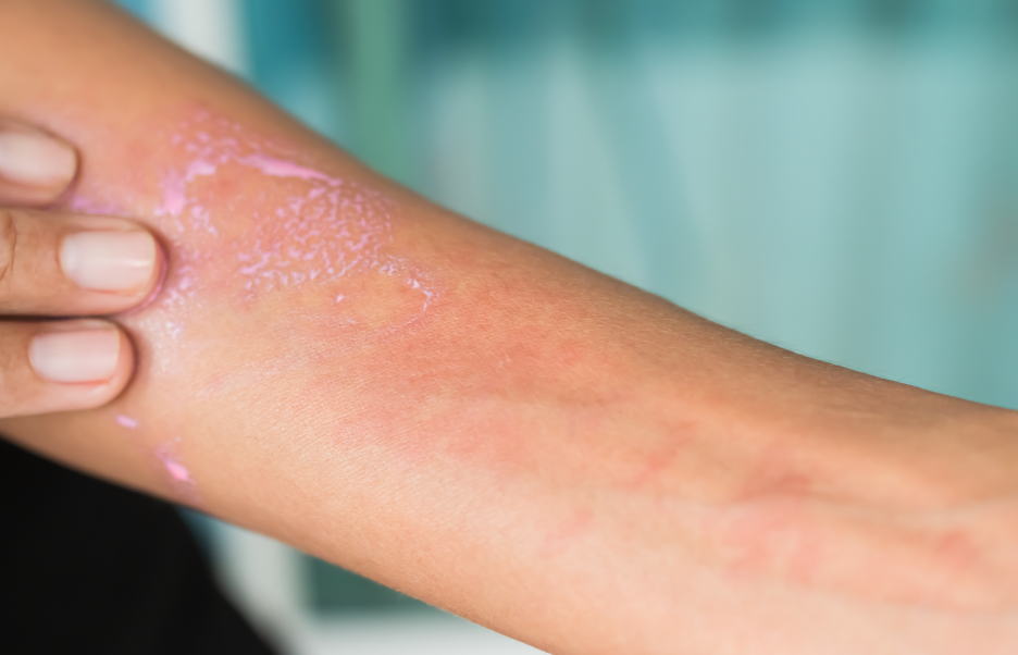 Cuidados diarios para reducir la picazón